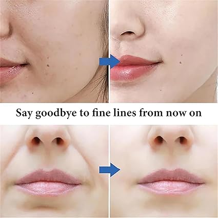 Spot Fading Urea Cream