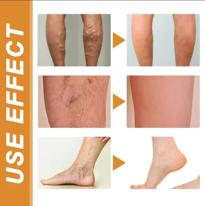Turmeric Vericose Vein Relief Spray | Imported | Free Delivery |