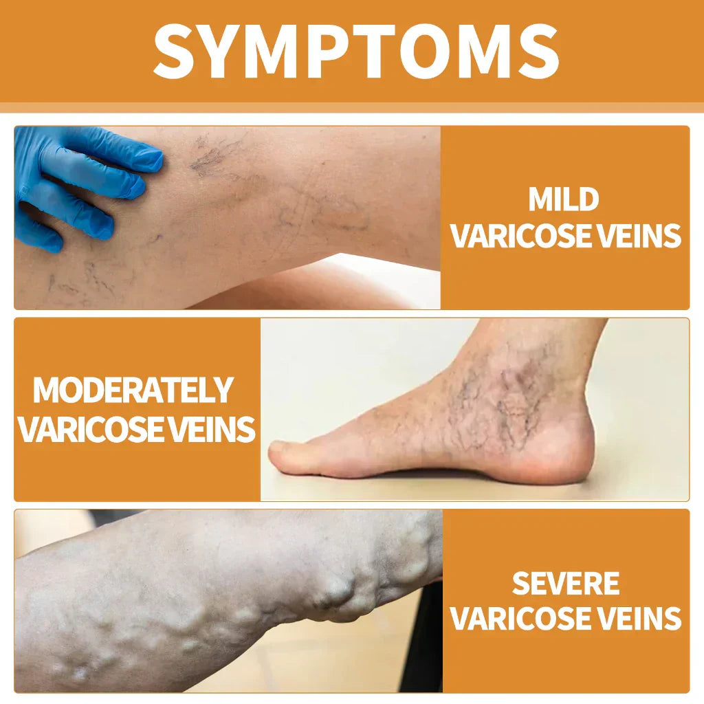 Turmeric Vericose Vein Relief Spray | Imported | Free Delivery |