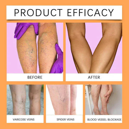 Turmeric Vericose Vein Relief Spray | Imported | Free Delivery |