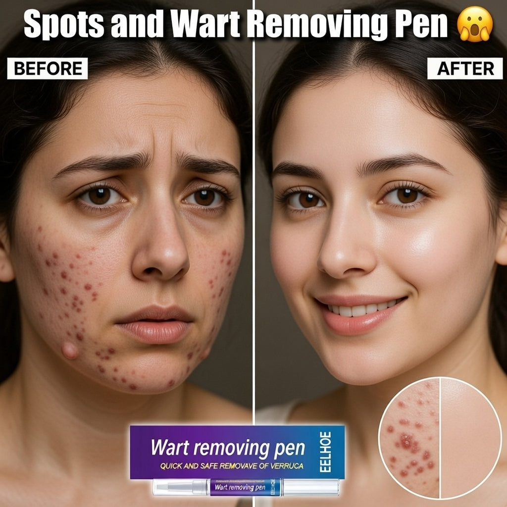 Warts & Moles Remover Pen (14 Days Money Back Guarantee)