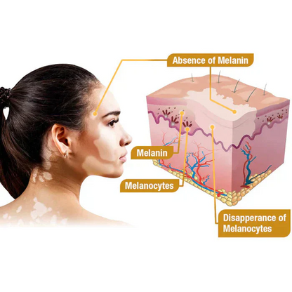 VitiGO™ Bee Venom Corrector Cream