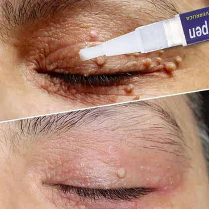 Warts & Moles Remover Pen (14 Days Money Back Guarantee)